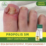 obat cantengan jempol kaki - obat tetes kuku cantengan bernanah - cantengan jari kaki tangan - cante