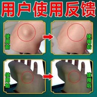 MXS腱鞘炎藥膏治療腕狹窄性關節腱鞘囊腫疼痛神網球肘鼓包專用藥現貨