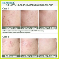 ♚ ▤ ⊙ HEMEIEL Sos Pimple Remover/Pimple Marks Acne Spot Treatment/Isotretinoin