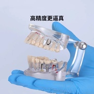 Removable Teeth Model Implant Disease Dentist Studying New Dental Model Teeth Implant Restoration Br
