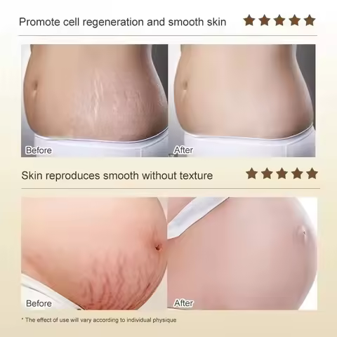Stretch Marks Permanent Removal Cream Eliminate Body Belly Stretch Marks Swelling Marks Remove Skin 