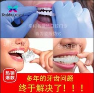 牙套吃飯神器仿真假牙套美白 矽膠 鍍膜門牙縫遮蓋蛀牙齙牙黃變白  露天拍賣