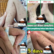 Ubat parut Hilangkan parut hitam Hilangkan parut kaki Menghilangkan bekas luka lama Scar Burns Parut