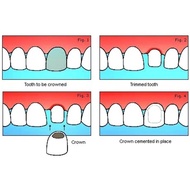 CROWN GIGI CROWN GIGI SARUNG BAGIAN ANTERIOR DEPAN