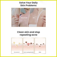 ✨ ❏ ∇ Safeguard DETOX Acne Soap Dual Use Wash 99.9% Bacteria New Old Packaging Random Chamomile Whi