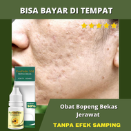 Propolis Brazil SM - Obat Buat Penghilang Bopeng Bekas Jerawat  - Bopeng Jerawat Bopeng Bekas Cacar 