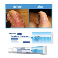 620【CW】 Effective Eczema Rash Urticaria Herbal Psoriasis Ointment Desquamation Anti itch Antibacteri