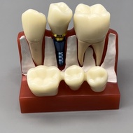 Dental 4 Times Implant Teeth Practice Model Dental Teach Implant Analysis Crown Bridge Removable Mod
