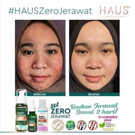 🔥PANTAS BERKESAN🔥SET JERAWAT HAUS🔥KESAN SEAWAL 2 HARI🔥SUPER POTENT HAUS🔥