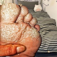 【Ready stock】Skintific nested keratolytic disease honeycombed sandworms on the solenest cutin releas