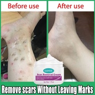 Scar Removal Cream Krim hilangkan parut hitam Menghilangkan bekas luka lama Ubat parut kaki Mosquito