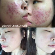 TST mask + Perliere 珍珠膏