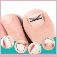 (COD) 2pcs Ingrown Toenail Corrector Pedicure Recover Embed Toe Nail Treatment Professional Ingrown 
