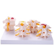 Human Anatomy Skeleton Spine 4-Stages Lumbar Vertebral Model Brain Skull Traumatic Teaching Supplies