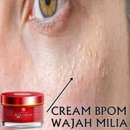 CREAM PENGHILANG MILIA BPOM CREAM MILIA Cara Menghilangkan Milia di Wajah