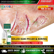 Obat Tetes Untuk Telapak Kaki Pecah-Pecah Obat Oles Gatal Sela Jari Kaki Selain Krim Kaki Pecah - Pe