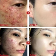 NEW REMOVE BLACKHEAD MUD MASK GREEN TEA FACE CLEAN STICK DISPEL PIMPLE BLEMISH SHRINK PORES OIL CONT