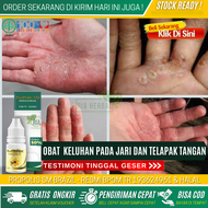 Obat Penghilang Gatal Kulit Karena Alergi Semen Obat Alami Dermatitis Kontak Kulit Telapak Tangan da