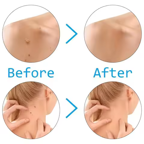 Tag Remover Kit Portable Skin Care Solution Face Mole Wart Micro Band Skin Tag Removal Tool For Home