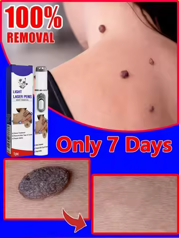 Stylo à lumière bleue pour résoudre les verrues, outils d'entretien des verrues, offre spéciale