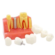 4X Implant Teeth model dental model dental teaching model