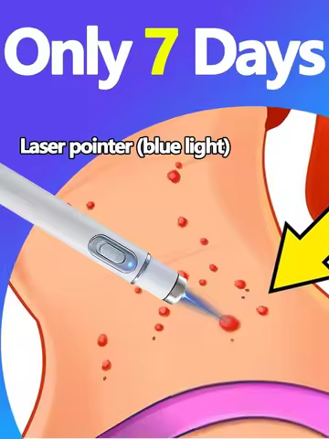 Sell Like Hot Cakes Generation-2 Laser Says Goodbye To all warts In 7 Days