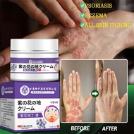 Eczema & Psoriasis Herbal Antifungal Cream 30g Quickly Relieves Itching & Removes Symptoms
