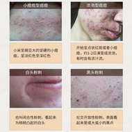 Face Cream Acne Marks Herbal Acne Removal Cream Acne Marks Small White Box Remove Semi-finished Prod