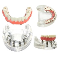 Dental Lower Tooth Implant Model Overdenture Teeth Removable Implant Model for Researching Medical D