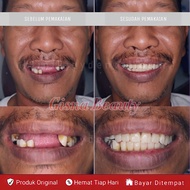 PALING KUAT !! Penambal gigi ompong murah Gigi palsu penambal ompong Penambal gigi ompong permanen o