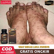 Obat Bekas Luka Koreng Hitam di Kaki Bekas Luka Lama Hitam Obat Bekas Luka Koreng Hitam Koreng Berna