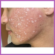 ☼ ◳ § TCA Peel/Cross Solution 100% 15ml