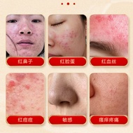 Rose Acne Cream Relieve Red Nose Red Face Red Blood Red Acne Discomfort Care External Health Care Cr