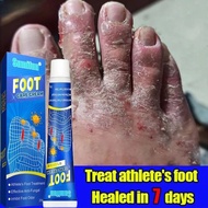 ubat kaki berbau ubat gatal kaki ubat kulat air kaki mengelupas Foot fungus beriberi itching Inhibit