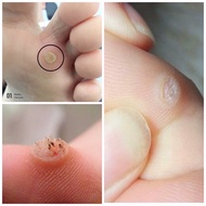 CORN PLASTER REMOVER 6Pcs Penghilang ketuat kaki ketuat tangan Ketuat seluruh badan skin tag remover