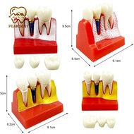 Dental Implant Model Teeth Model Dental Teaching Model Removable Tooth Model
