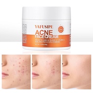 Acne Treatment for Face for Hormonal Cystic Stubborn Acne Cream for Sensitive Skin Teens Adults Wome