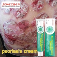 Jemeesen Itchy Skin Cream Ringworm Cream  Allergy Medicine Steroid Free Suitable For All Eczema