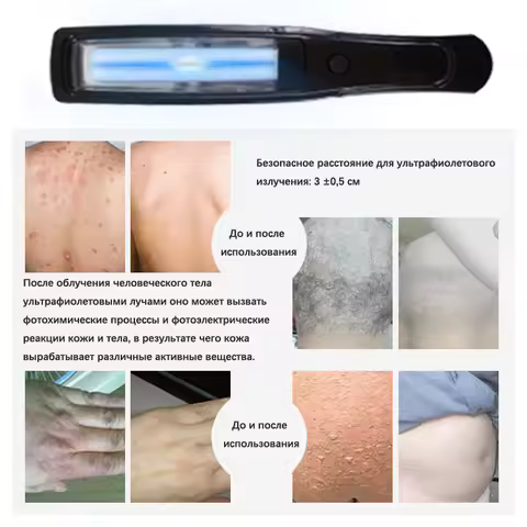 Handled band uvb 311nm uvb phototherapy 311 nm UVB phototherapy Lamp for Psoriasis vitiligo treatmen