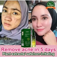 acne serum acne spot treatment acne scar remove 30ml Whitening and moisturizing Gentle acne scar rep