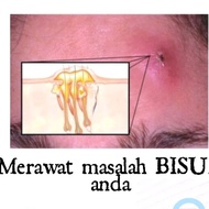 BISUL & Anal Fistula [Homeopathy]