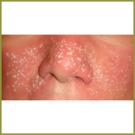 ▫ ♝ ❡ TCA Peel Solution / TCA Cross 80% 20ml for scars and tattoo removal