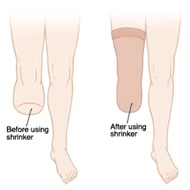 Stokin Kaki Kudung/ Stump Shrinker Amputation / Easy Stump Bandage for pre-prosthetic