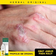 Obat Eksim Kering - Obat Oles Eksim Kering Menahun - Obat Eksim Parah - Obat Eksim Basah Propolis SM