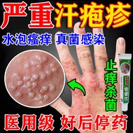 Small Hand Blister Sweat Herpes Eczema Red Herpes Anti-Itching Anti-Sweat Herpes External Use Naught