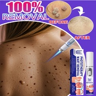 Warts Remover Pen Original Mole Remover Skin Tag Remover Remove Freckles And Melanin Spots