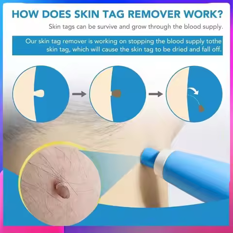 New 2 in1 Painless Auto Skin Tag Mole Wart Removal Kit Body Wart Dot Treatments Remover Beauty Healt
