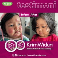 [RECOMMENDED]WIDURI Psoriasis Eczema Cream Antifungal Antibacterial Itchy Ubat Gatal Kurap Krim Ezce