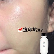 Quba Cream Remove Acne Pit Acne Marks Acne Marks Holes Repair Filling Regeneration Reduce Acne Marks