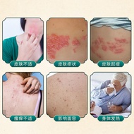 With Herpes Cream Nettle Reproductive Herpes External Use Ointment Relieve Skin Itching Pain Herpes 